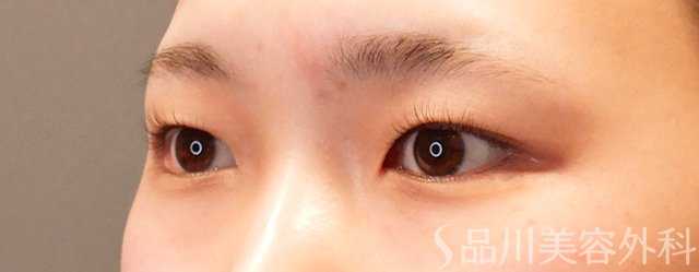 症例NO.70028のBEFORE写真