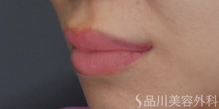 症例NO.71258のAFTER写真