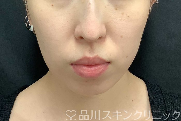 症例NO.69775のAFTER写真