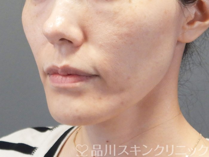 症例NO.75242のBEFORE写真