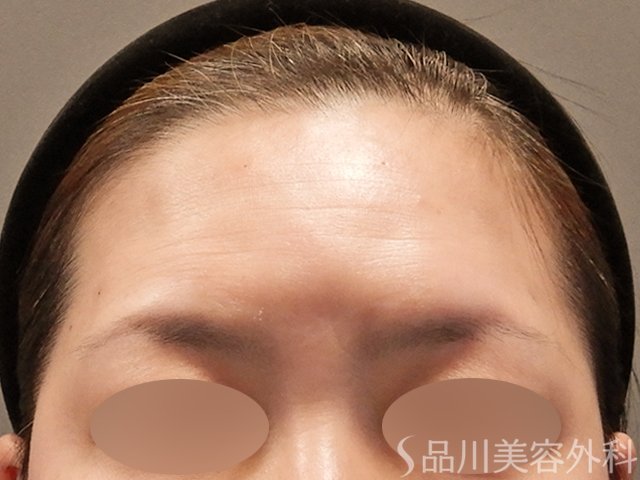 症例NO.72800のAFTER写真