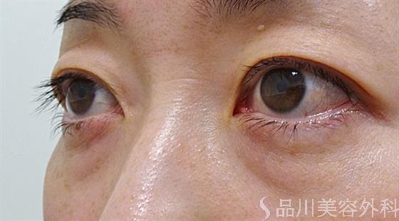 症例NO.54274のBEFORE写真
