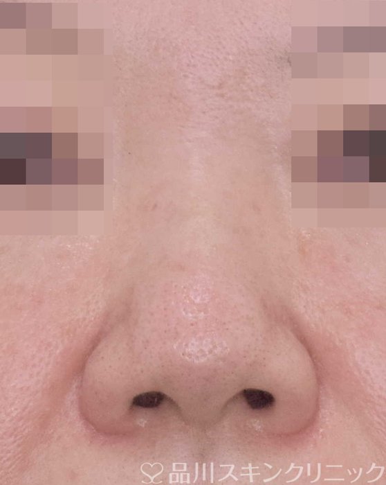 症例NO.65347のBEFORE写真