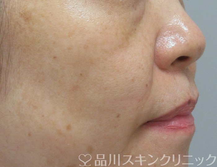 症例NO.72869のAFTER写真