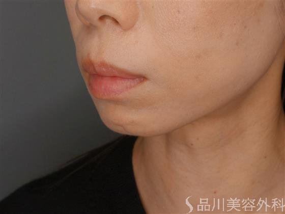 症例NO.59510のBEFORE写真
