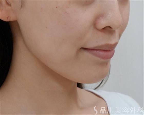 症例NO.37904のBEFORE写真