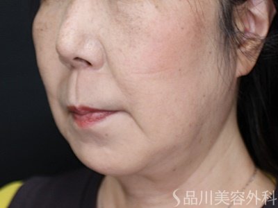 症例NO.71793のAFTER写真