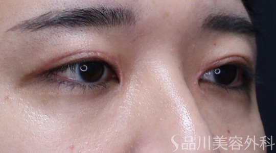 症例NO.71507のAFTER写真