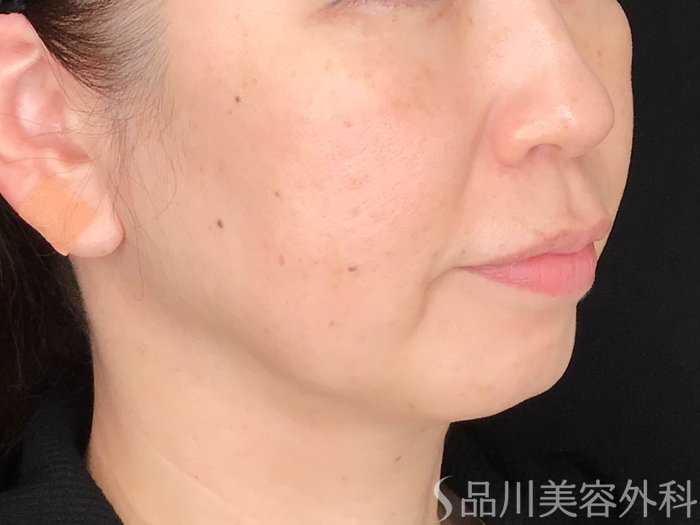 症例NO.62960のBEFORE写真