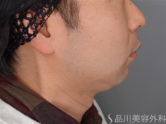 症例NO.53677のBEFORE写真