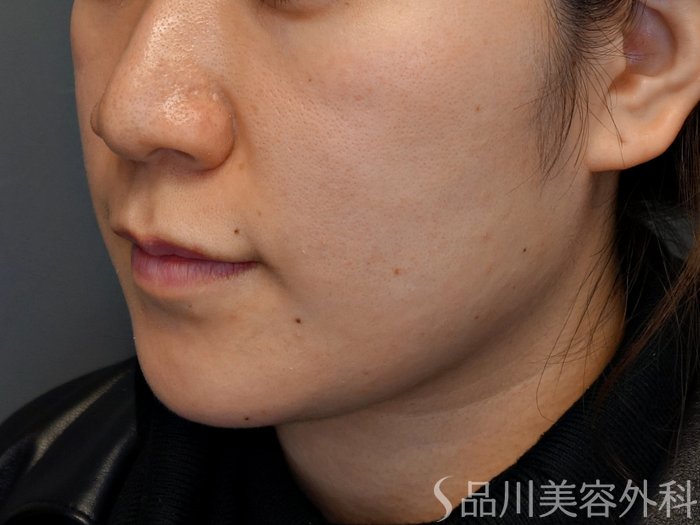 症例NO.73840のBEFORE写真