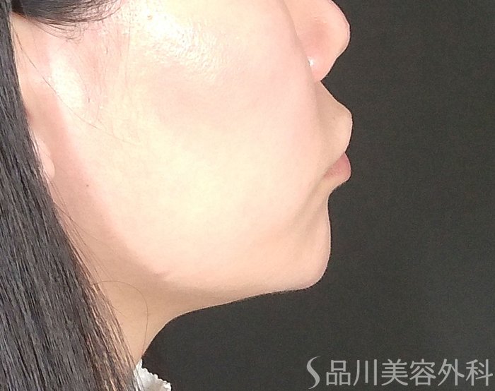 症例NO.67837のBEFORE写真
