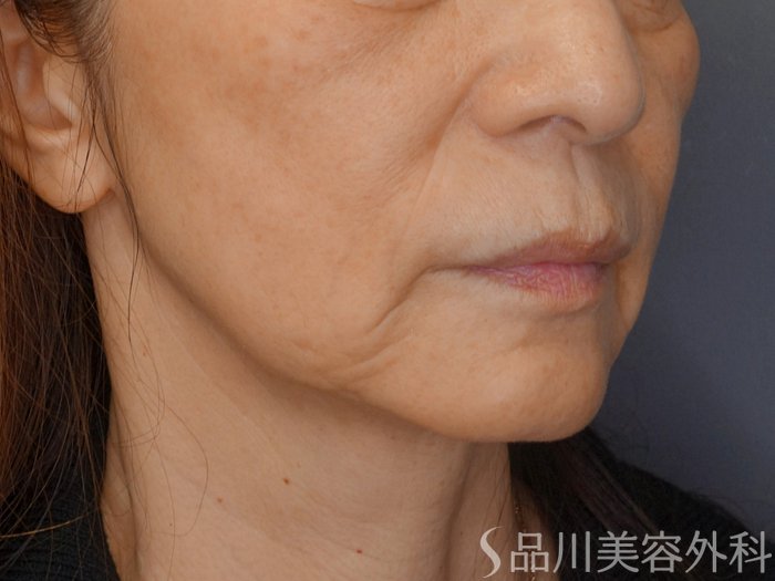 症例NO.75095のBEFORE写真