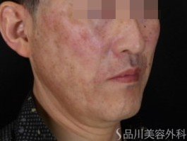 症例NO.70903のAFTER写真