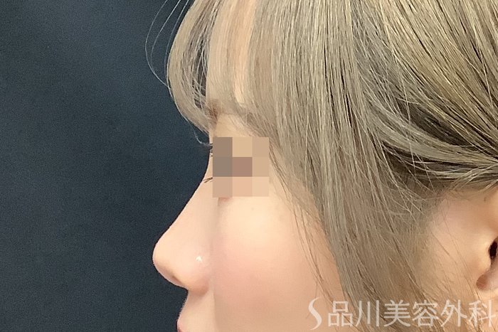 症例NO.71637のBEFORE写真