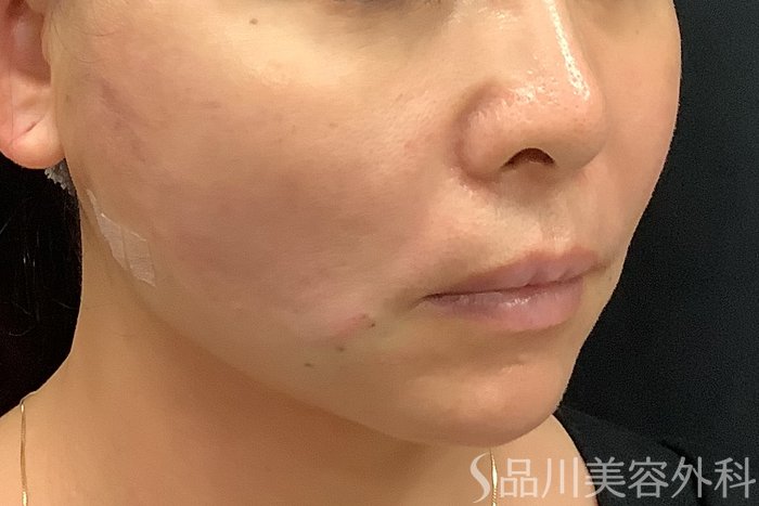 症例NO.71245のAFTER写真