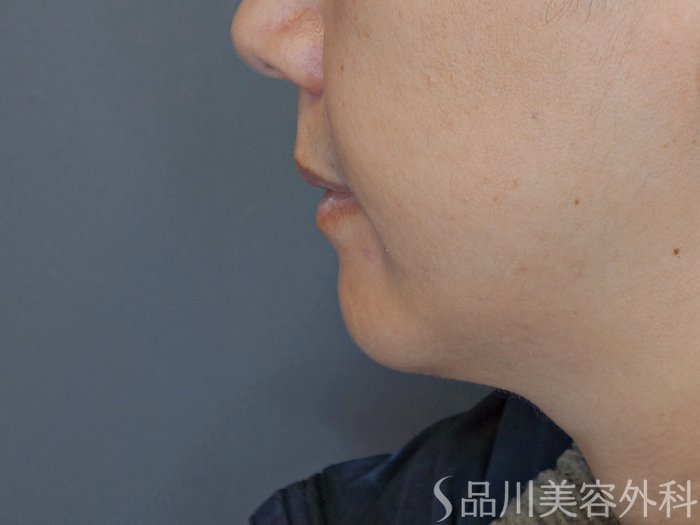 症例NO.72948のBEFORE写真