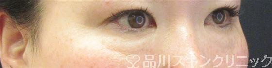 症例NO.59899のBEFORE写真