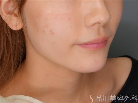 症例NO.51571のAFTER写真