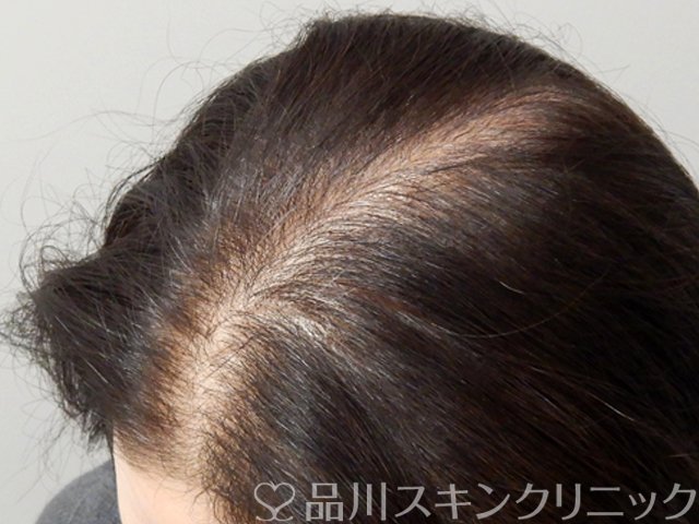 症例NO.68421のAFTER写真