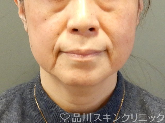 症例NO.63063のBEFORE写真