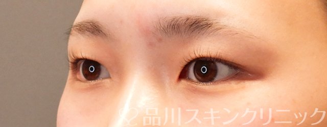 症例NO.70028のBEFORE写真