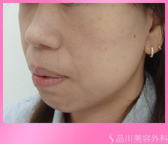 症例NO.4052のAFTER写真