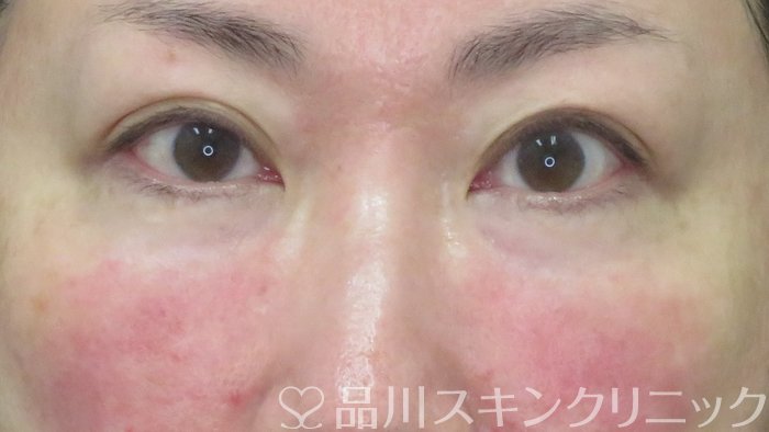 症例NO.72441のAFTER写真