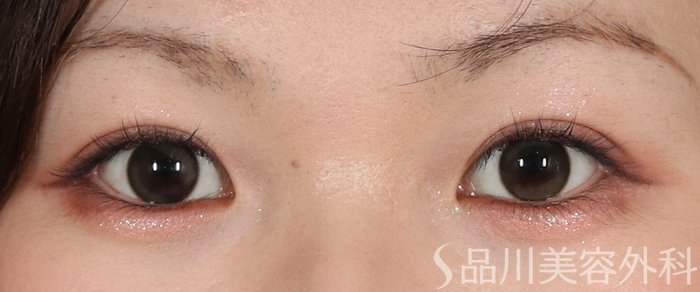 症例NO.73632のAFTER写真