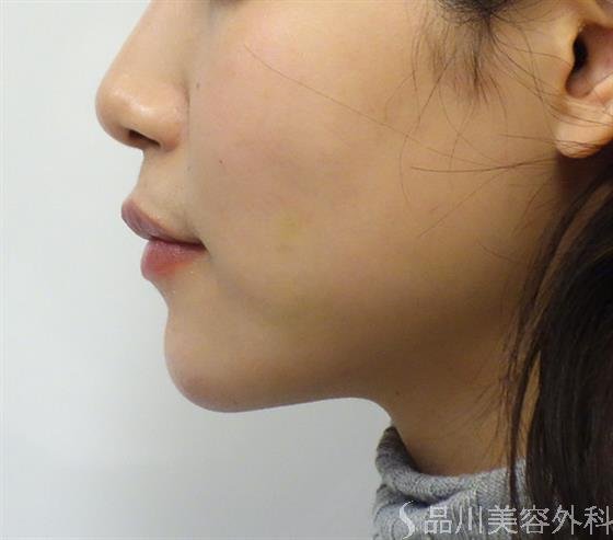 症例NO.39986のBEFORE写真
