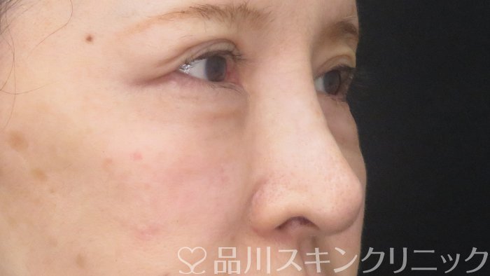 症例NO.72715のAFTER写真