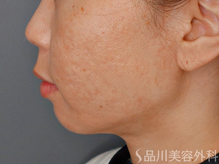 症例NO.73351のAFTER写真