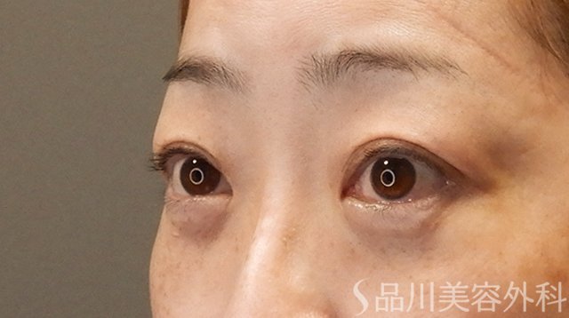 症例NO.75229のAFTER写真