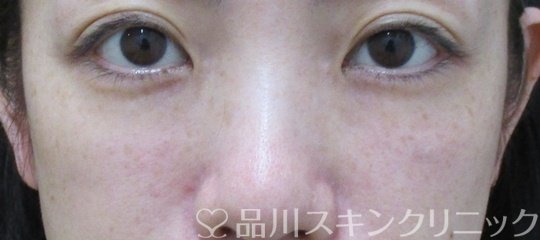 症例NO.74796のAFTER写真