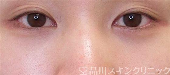 症例NO.61584のAFTER写真