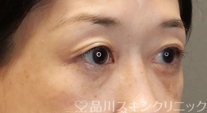 症例NO.69557のAFTER写真