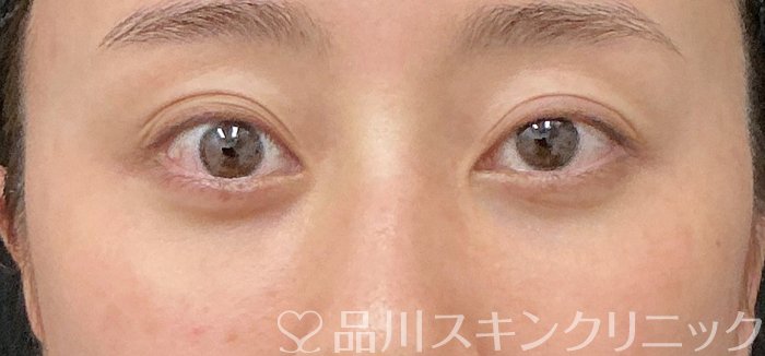 症例NO.74931のBEFORE写真