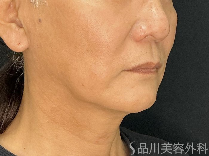 症例NO.71749のBEFORE写真