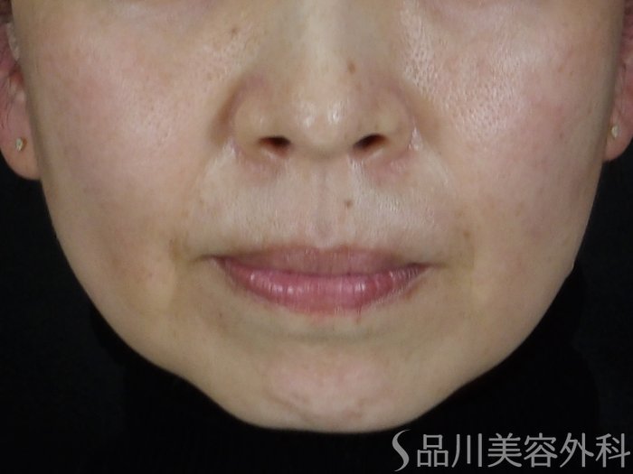 症例NO.69833のBEFORE写真
