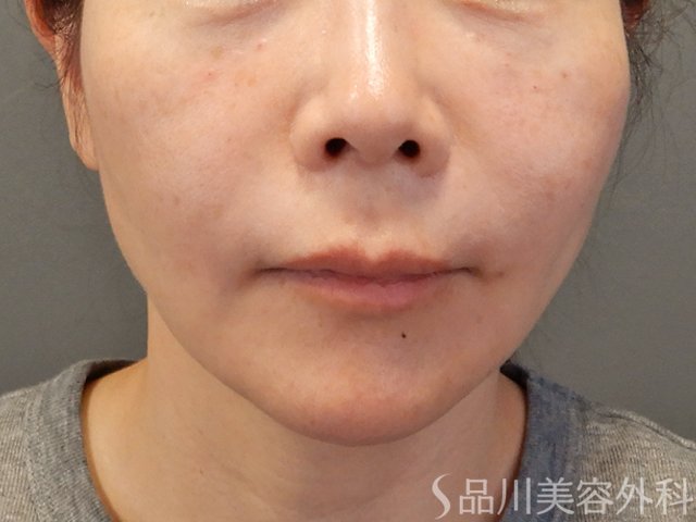 症例NO.74471のAFTER写真