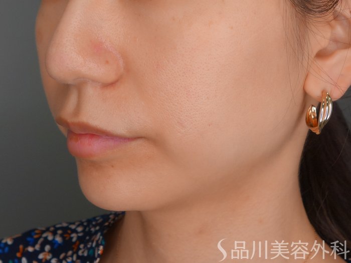 症例NO.73196のBEFORE写真