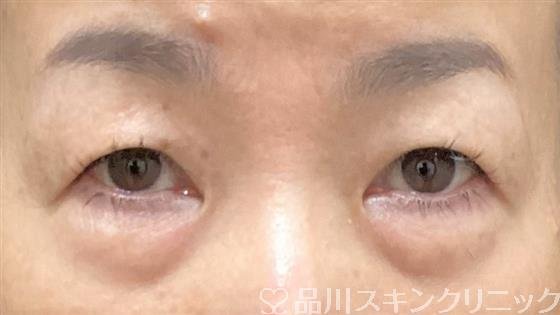 症例NO.60467のBEFORE写真