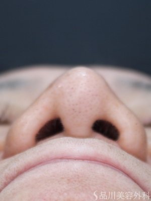 症例NO.73556のAFTER写真