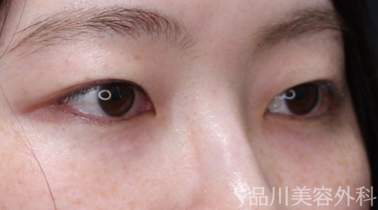 症例NO.74368のBEFORE写真
