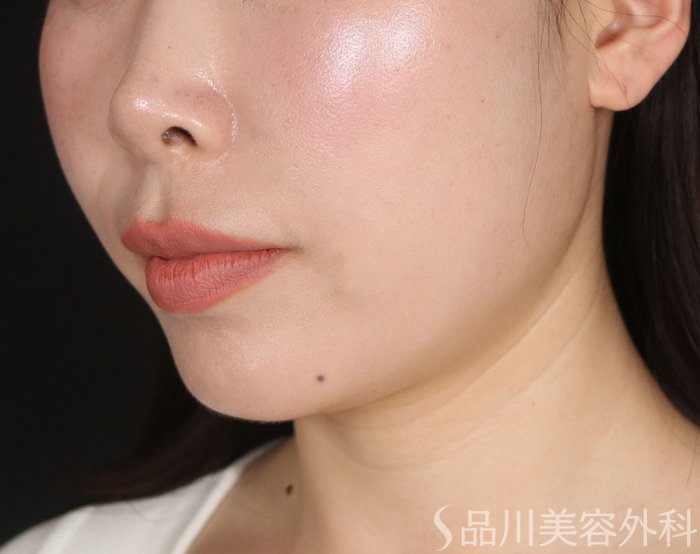 症例NO.73315のAFTER写真