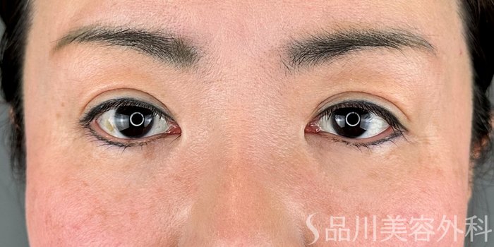 症例NO.69462のAFTER写真