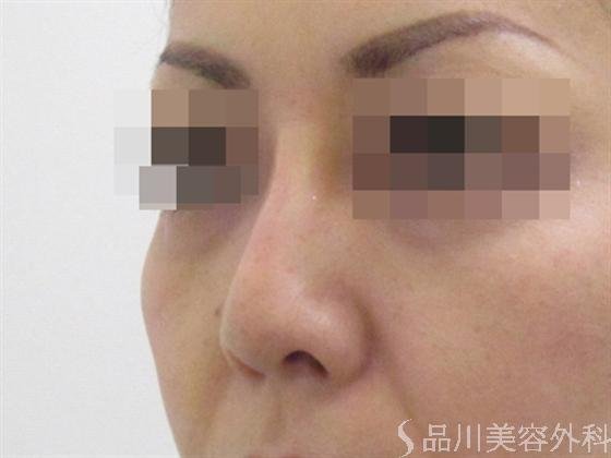 症例NO.3038のAFTER写真