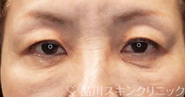 症例NO.65484のBEFORE写真