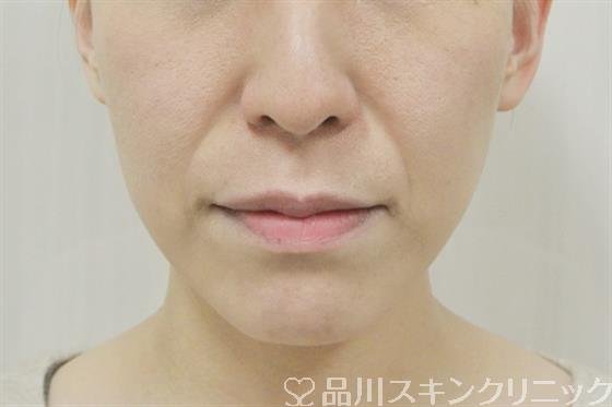 症例NO.40257のBEFORE写真