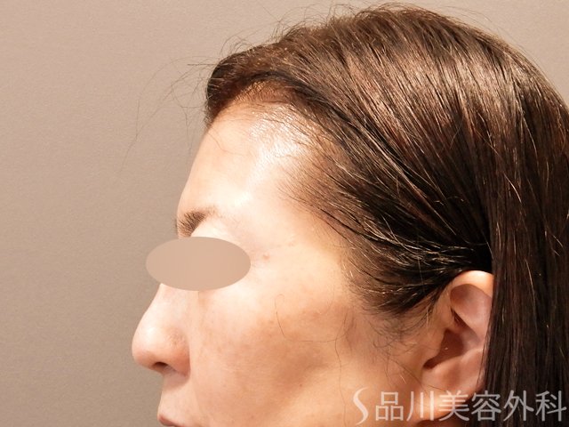 症例NO.71084のBEFORE写真